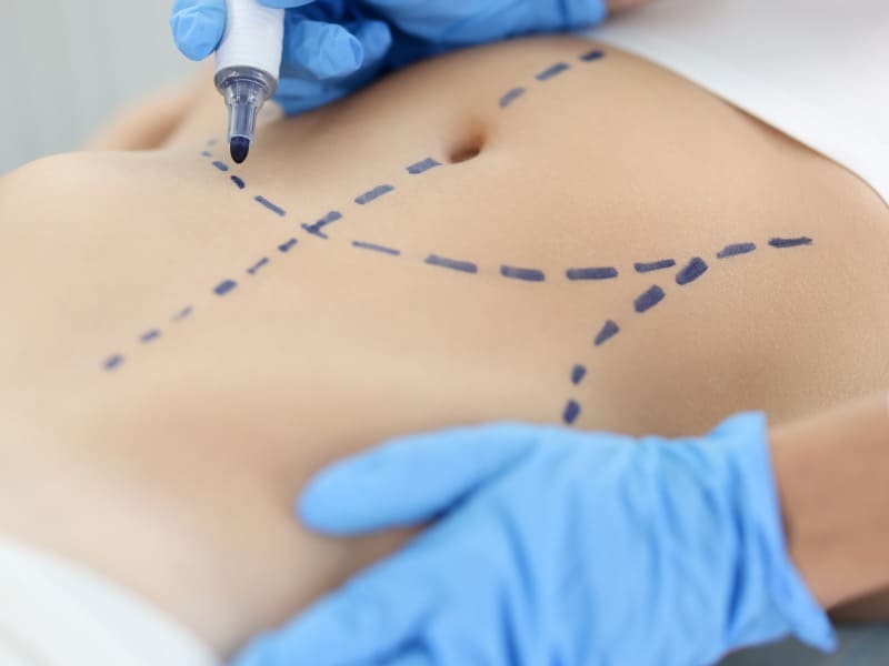Tipos de cicatrizes da abdominoplastia
