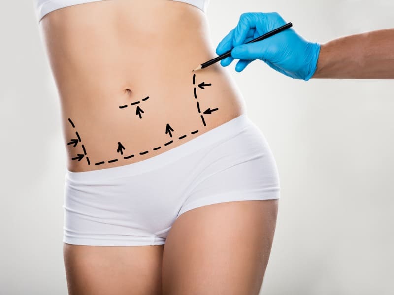 Entendendo os Riscos e Complicações da Abdominoplastia
